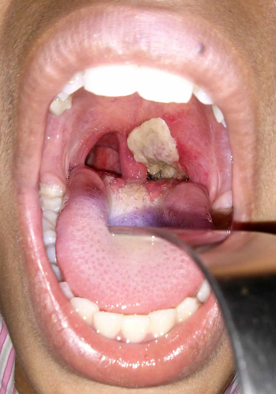 An open mouth with classic signs of diphtheria